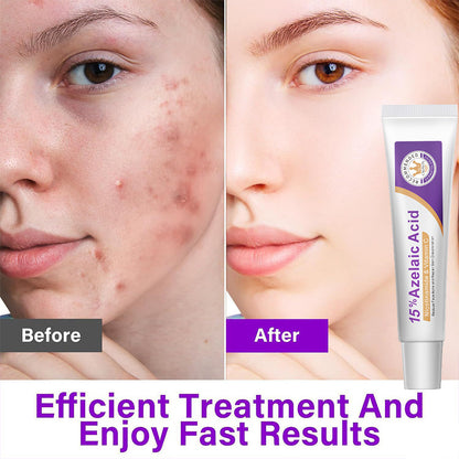 Azelaic Acid Facial Essence for Acne Scar Treatment
