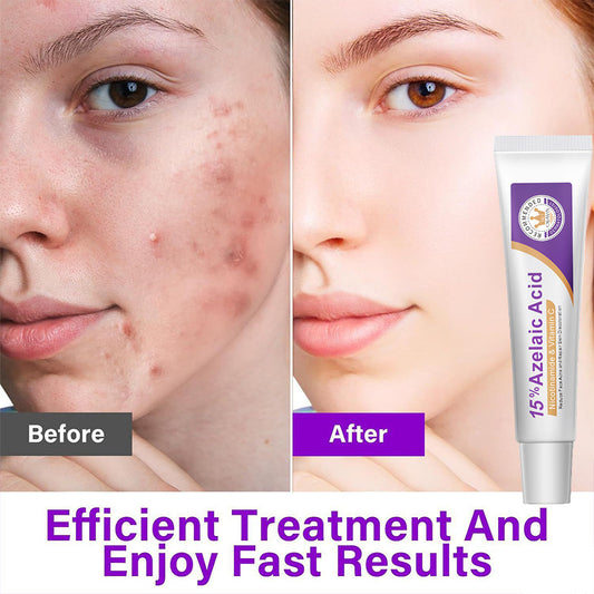 Azelaic Acid Facial Essence for Acne Scar Treatment